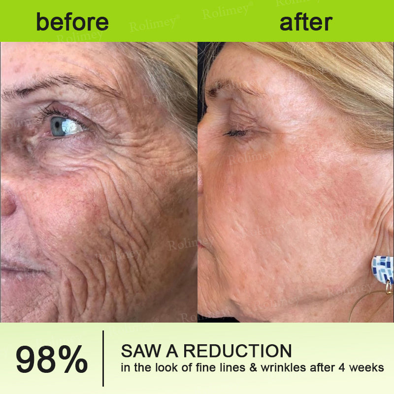 👨⚕️✅Made and shipped from the USA 🔆Rolimey® Botox & Vita-A Retinol Shot Wrinkle-Lift Tightening cream - Last Day Promotion 70% OFF ⏰