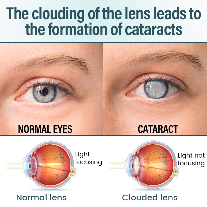 Spzv® OptiFusion Nano очен серум 👩⚕️ Нанотехнология за възстановяване на ясно зрение, без очила, без операция ⏰