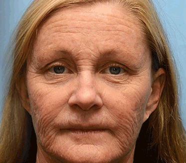 👨⚕️✅Made and shipped from the USA 🔆Rolimey® Botox & Vita-A Retinol Shot Wrinkle-Lift Tightening cream - Last Day Promotion 70% OFF ⏰