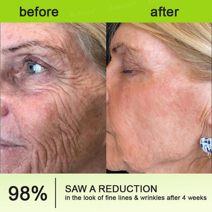 Произведено и изпратено от САЩ ✅ Rolimey® Botox & Vita-A Retinol Shot Крем против бръчки и за стягане на кожата – Последен ден на промоцията: 70% ОТСТЪПКА!