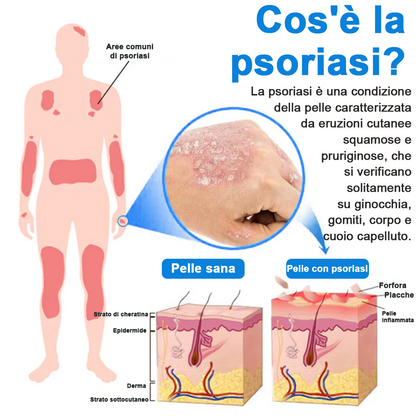 Официален магазин: Zvoevo® Спрей с магнезий и натурални билки за псориазис ☘️(Облекчава псориазис и екзема, подобрява бактериални инфекции в гениталната зона, третира акне и брадавици, облекчава ставни и невропатични болки)⏰