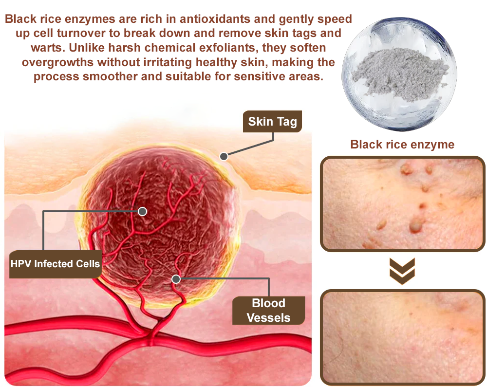 Zvoevo® Black Rice Skin Repair Essence Cream 👩🏻‍⚕️ Сертифициран от MHRA (Премахва брадавици и кожни образувания, подобрява натрупването на кератин и себорейния дерматит, фоликуларна кератоза, рак на кожата и старчески петна) ⏰