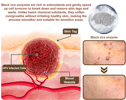 Zvoevo® Black Rice Skin Repair Essence Cream 👩🏻‍⚕️ Сертифициран от MHRA (Премахва брадавици и кожни образувания, подобрява натрупването на кератин и себорейния дерматит, фоликуларна кератоза, рак на кожата и старчески петна) ⏰