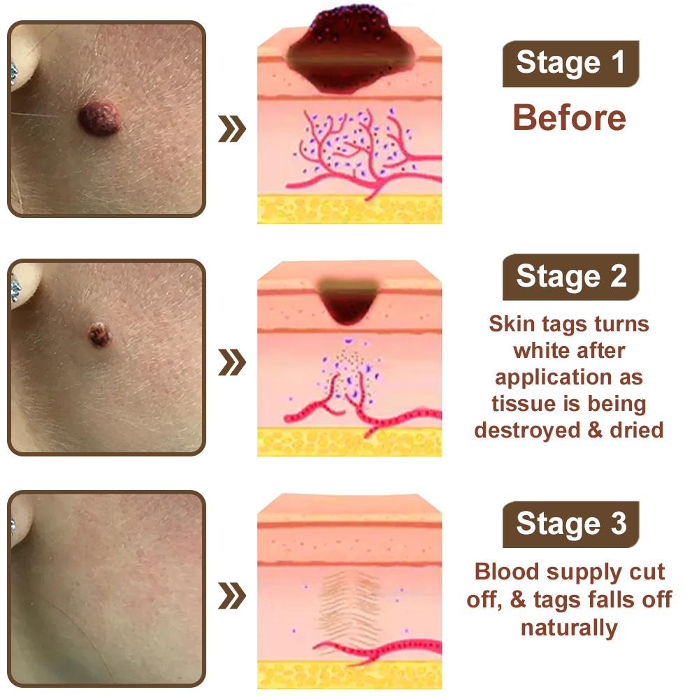 Zvoevo® Black Rice Skin Repair Essence Cream 👩🏻‍⚕️ Сертифициран от MHRA (Премахва брадавици и кожни образувания, подобрява натрупването на кератин и себорейния дерматит, фоликуларна кератоза, рак на кожата и старчески петна) ⏰