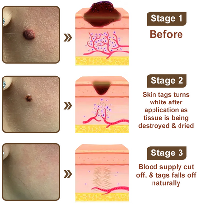 Zvoevo® Black Rice Skin Repair Essence Cream 👩🏻‍⚕️ Сертифициран от MHRA (Премахва брадавици и кожни образувания, подобрява натрупването на кератин и себорейния дерматит, фоликуларна кератоза, рак на кожата и старчески петна) ⏰