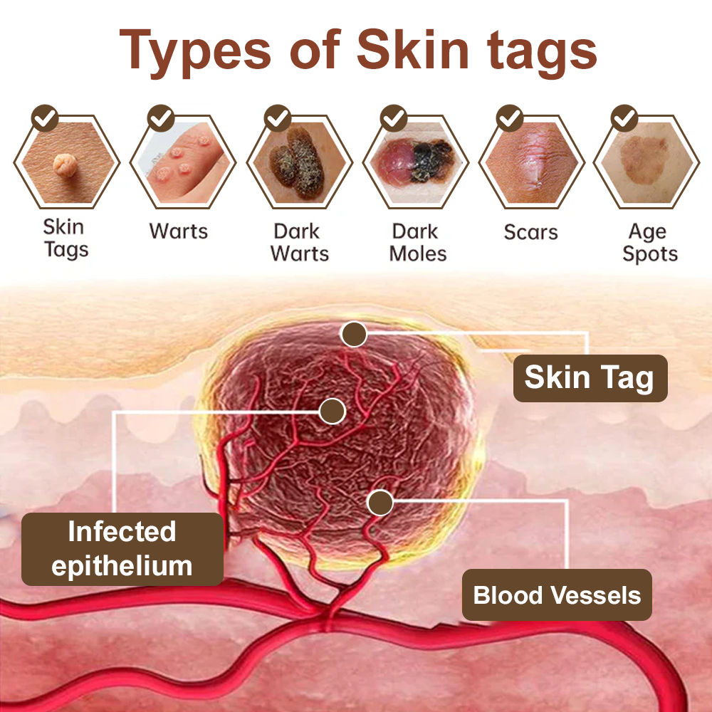 Zvoevo® Black Rice Skin Repair Essence Cream 👩🏻‍⚕️ Сертифициран от MHRA (Премахва брадавици и кожни образувания, подобрява натрупването на кератин и себорейния дерматит, фоликуларна кератоза, рак на кожата и старчески петна) ⏰