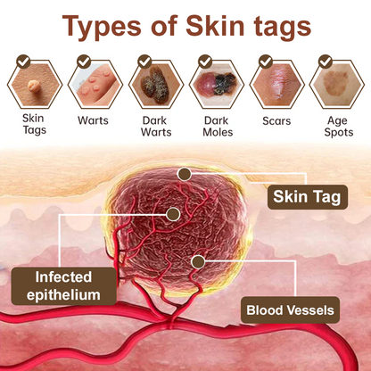 Zvoevo® Black Rice Skin Repair Essence Cream 👩🏻‍⚕️ Сертифициран от MHRA (Премахва брадавици и кожни образувания, подобрява натрупването на кератин и себорейния дерматит, фоликуларна кератоза, рак на кожата и старчески петна) ⏰