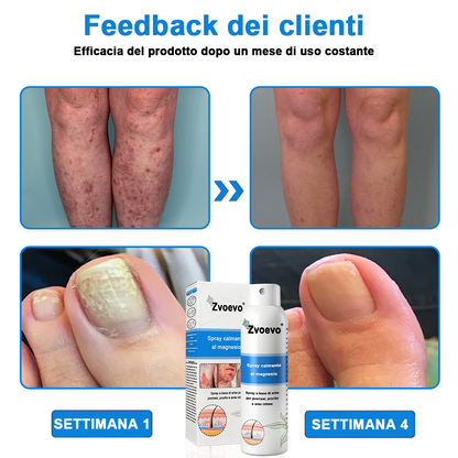 Официален магазин: Zvoevo® Спрей с магнезий и натурални билки за псориазис ☘️(Облекчава псориазис и екзема, подобрява бактериални инфекции в гениталната зона, третира акне и брадавици, облекчава ставни и невропатични болки)⏰