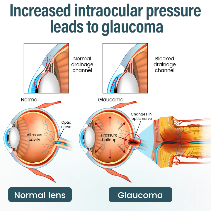 Spzv® OptiFusion Nano очен серум 👩‍⚕️ Нанотехнология за възстановяване на ясно зрение, без очила, без операция ⏰