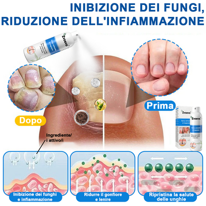 Официален магазин: Zvoevo® Спрей с магнезий и натурални билки за псориазис ☘️(Облекчава псориазис и екзема, подобрява бактериални инфекции в гениталната зона, третира акне и брадавици, облекчава ставни и невропатични болки)⏰